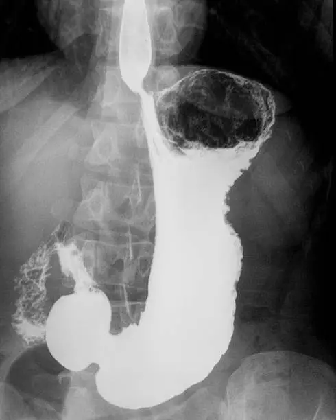 Photo of X-ray image of stomach