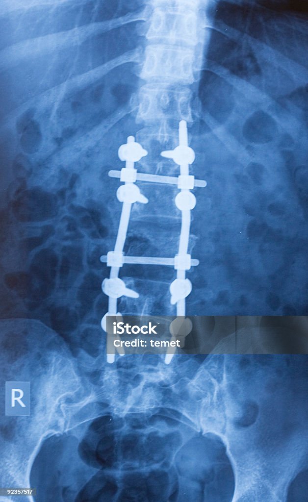 Immagine a raggi X di vertebra lombosacrale - Foto stock royalty-free di Frattura