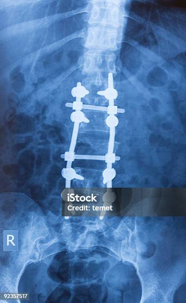 Immagine A Raggi X Di Vertebra Lombosacrale - Fotografie stock e altre immagini di Frattura - Frattura, Rotto, Intervento chirurgico