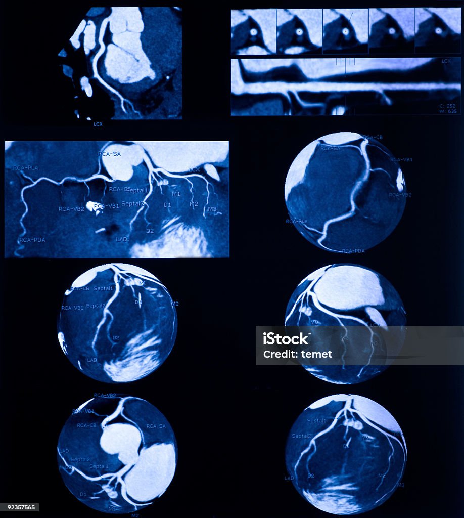 Angiografía coronaria por multidetector tomografía computarizada (computed tomography - Foto de stock de Anatomía libre de derechos