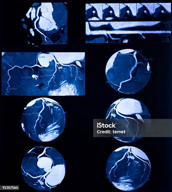 Angiografía Coronaria Por Multidetector Tomografía Computarizada Computed Tomography Foto de stock y más banco de imágenes de Anatomía