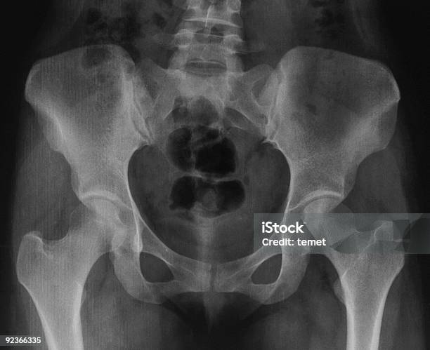 X선 영상을 골반 0명에 대한 스톡 사진 및 기타 이미지 - 0명, X-레이, 건강관리와 의술