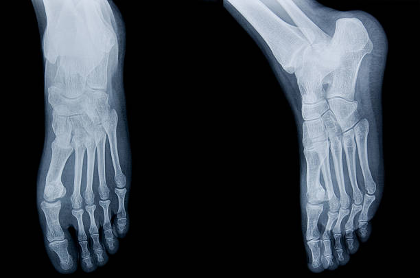 menschliches bein x-ray - bending human foot ankle x ray image stock-fotos und bilder