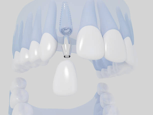 istock Dental implant 923813804