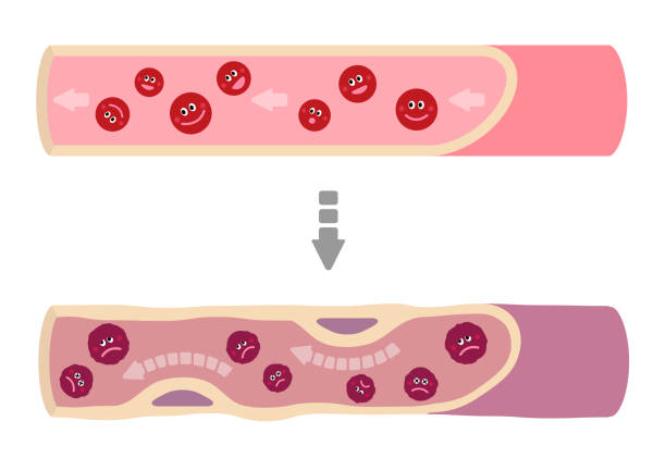 иллюстрация того, что здоровая кровь превращается в мутную кровь. - human artery cholesterol atherosclerosis human heart stock illustrations