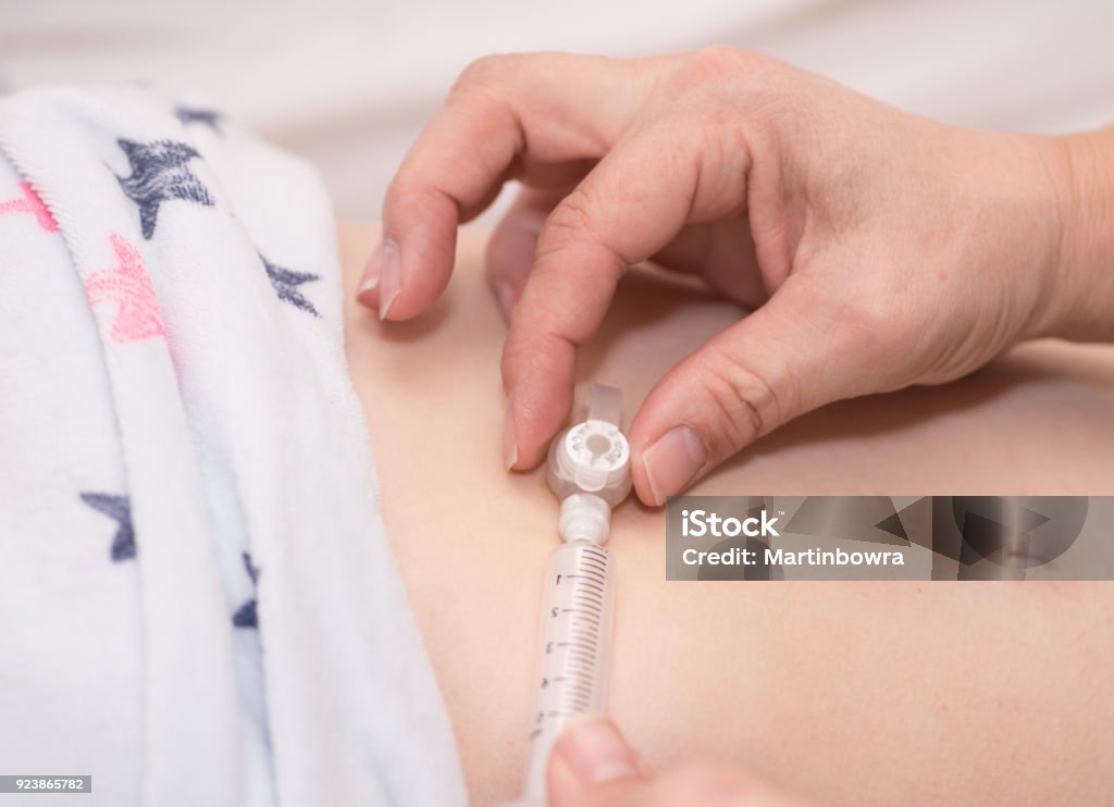 A medical feeding tube A nurse giving medicine and fluids via a feeding tube which has been placed through the stomach wall of a young Nasogastric Tube Stock Photo