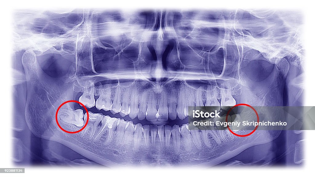 Woman x-ray of the teeth wisdom teeth horizontal pozition Woman x-ray of the teeth wisdom teeth horizontal pozition problem dentistry medicine Teeth Stock Photo