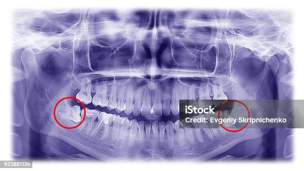 Woman Xray Of The Teeth Wisdom Teeth Horizontal Pozition Stock Photo - Download Image Now
