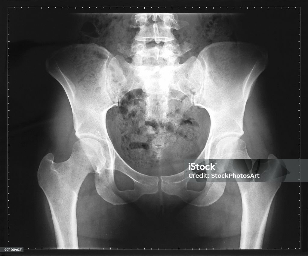 X-ray of женщина, таза и позвоночного столба - Стоковые фото Рентгеновский снимок роялти-фри