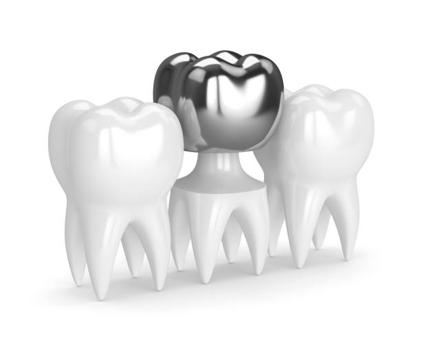 istock 3d render of teeth with dental crown amalgam filling 924031266