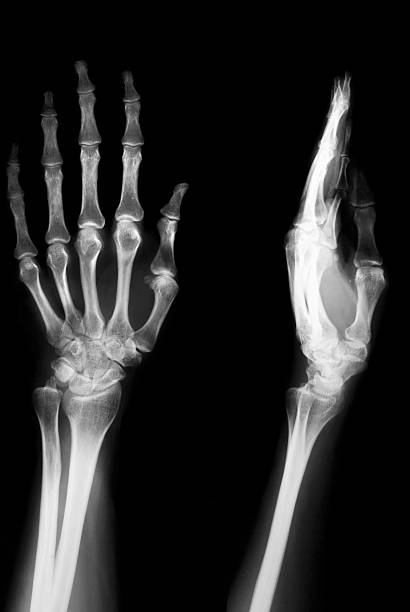Bilateral hand graph on negatoscope,female hand with osteporosis