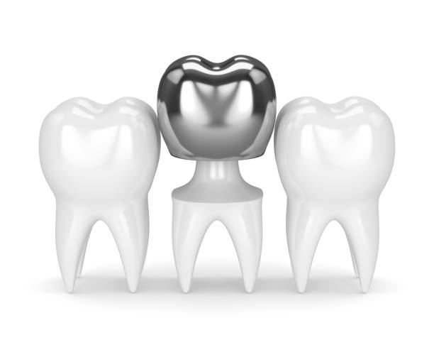 istock 3d render of teeth with dental crown amalgam filling 924034786