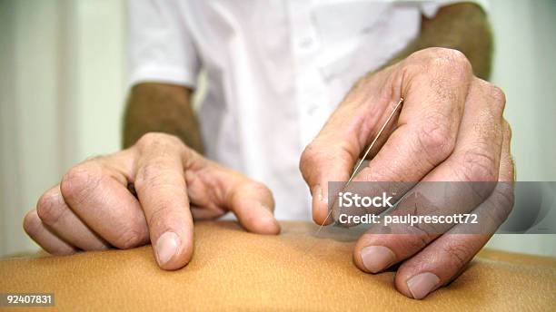 Acupunctura - Fotografias de stock e mais imagens de Acupuntura - Acupuntura, Homens, Adulto