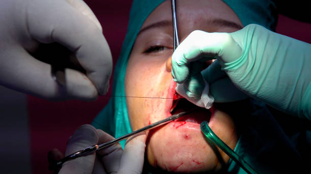 Dentist doctor stitch wound stitches after surgery of oral cyst removal stock photo