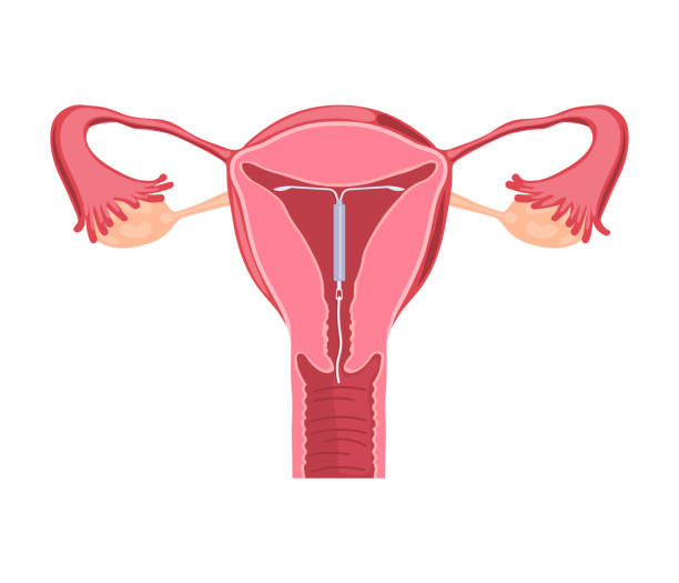 illustrations, cliparts, dessins animés et icônes de dispositif intra-utérin. méthode de contraception - iud