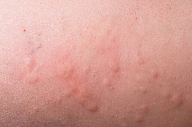 hives - angioedema ストックフォトと画像
