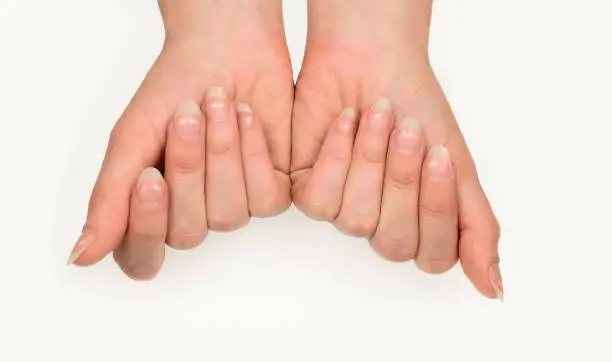Leukonychia. Woman nails with white spots isolated on white. Leuconychia partialis punctata or milk nails.