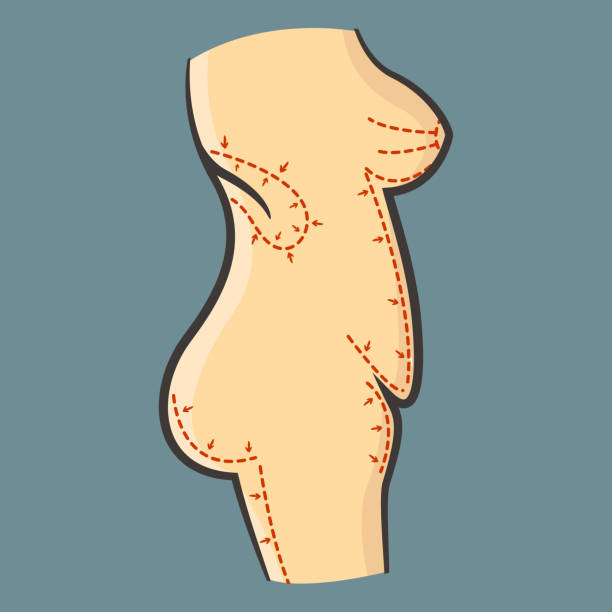 wektor ilustracja ludzkiego ciała do liposukcji - women the human body body hip stock illustrations