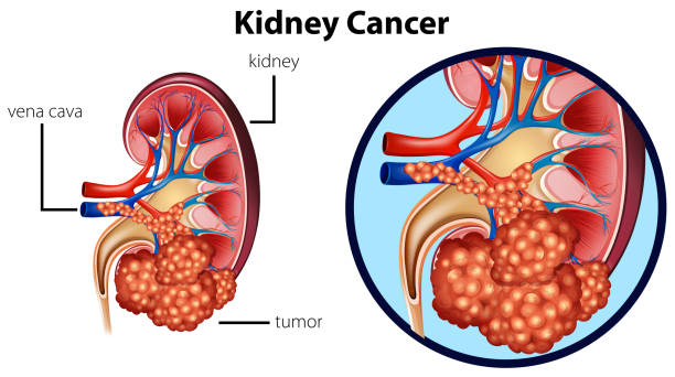 ilustraciones, imágenes clip art, dibujos animados e iconos de stock de diagrama que muestra cáncer de riñón - kidney cancer