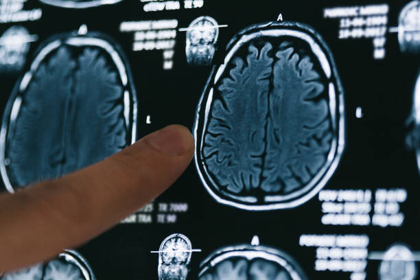 магнитно-резонансная томография - brain mri scan alzheimers disease medical scan стоковые фото и изображения