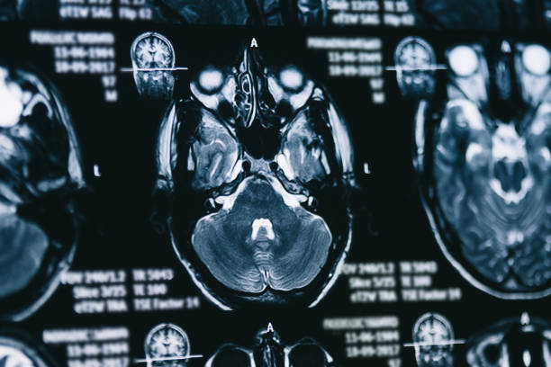 脳の x 線像 - brain mri scan alzheimers disease medical scan ストックフォトと画像