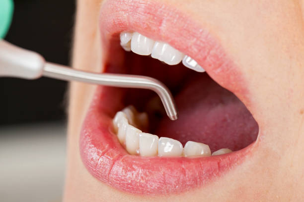 Close up picture of dental air flow treatment, young female patient's oral cavity