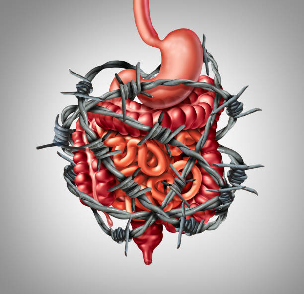 Painful Digestion Painful digestion IBS or irritable bowel syndrome and intestine pain or Intestinal discomfort inflammation problem or constipation as barbed wire with 3D illustration elements. irritable bowel syndrome photos stock pictures, royalty-free photos & images