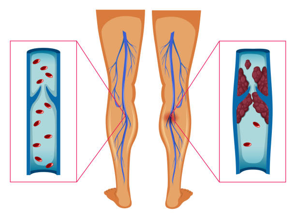 ilustraciones, imágenes clip art, dibujos animados e iconos de stock de diagrama que muestra el coágulo de sangre en las piernas humanas - coágulo de sangre