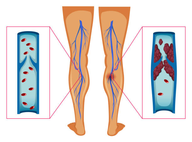 illustrations, cliparts, dessins animés et icônes de schéma montrant le caillot de sang dans les jambes humaines - thrombose