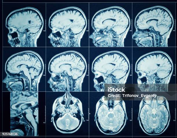 Mri Of The Brain Stock Photo - Download Image Now - MRI Scanner, Human Brain, People