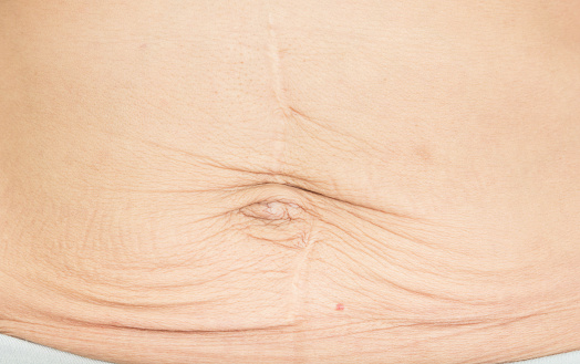 wrinkles Skin from pregnancy