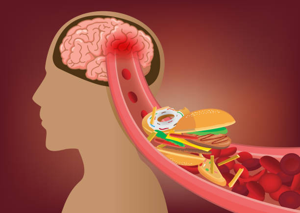 Blood can't flow into human brain because fast food made clogged arteries. Blood can't flow into human brain because fast food made clogged arteries. Illustration about stoke disease and medical concept. clogged artery stock illustrations