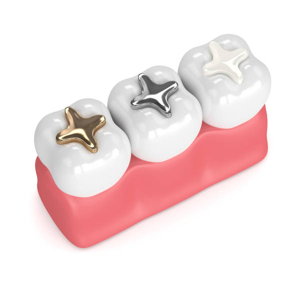 istock 3d render of teeth with different types of dental filling 925324716