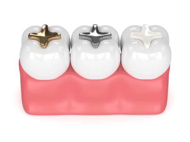 istock 3d render of teeth with different types of dental filling 925327270