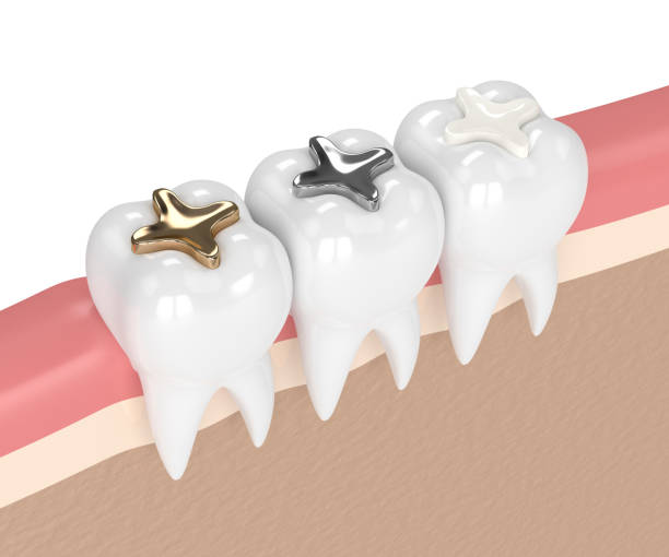 istock 3d render of teeth with different types of dental filling 925327976