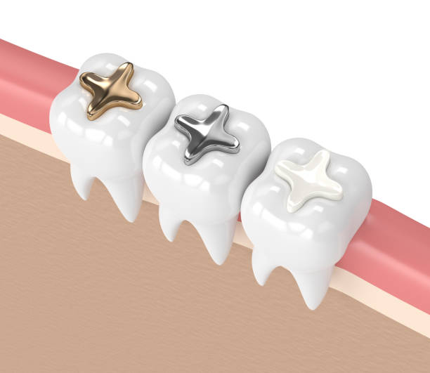 istock 3d render of teeth with different types of dental filling 925328752