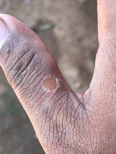 istock Wound injury at finger from hard work no blood 925333078