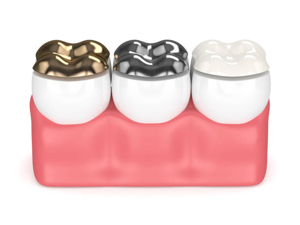 istock 3d render of teeth with different types of dental filling 925340118