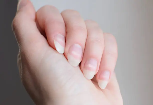 Leukonychia. Woman nails with white spots. Leuconychia partialis punctata or milk nails.