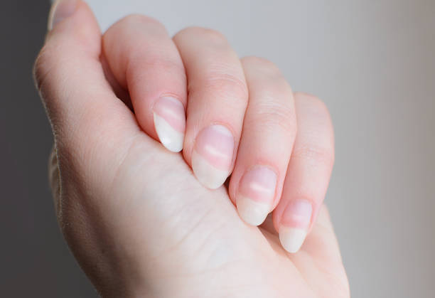 leukonychia. kobieta paznokcie z białymi plamami. leuconychia partialis punctata lub paznokcie mleczne. - punctata zdjęcia i obrazy z banku zdjęć