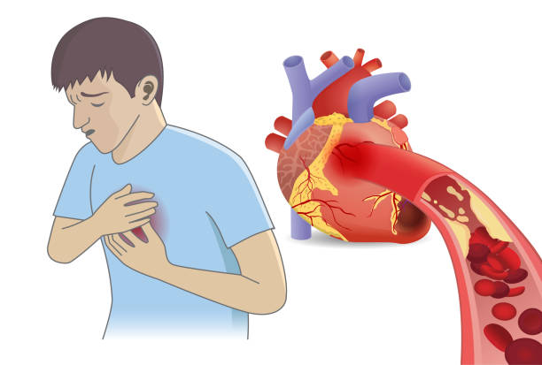 człowiek ma ból w klatce piersiowej z komórek krwi nie może płynąć do serca przez tłuszczowych. - human artery cholesterol atherosclerosis human heart stock illustrations