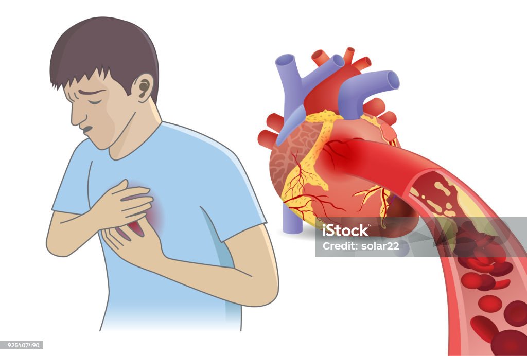 Man have chest pain from blood cell can't flow into heart by fatty. Man have chest pain from blood cell can't flow into heart by fatty. Illustration about Coronary Artery Disease and medical concept. Chest Pain stock vector