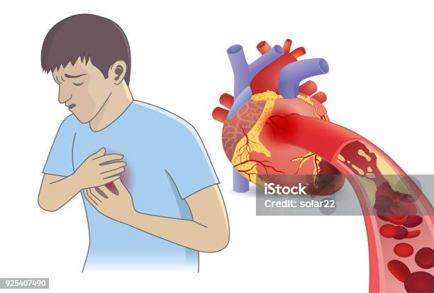 Man Have Chest Pain From Blood Cell Cant Flow Into Heart By Fatty Stock Illustration - Download Image Now