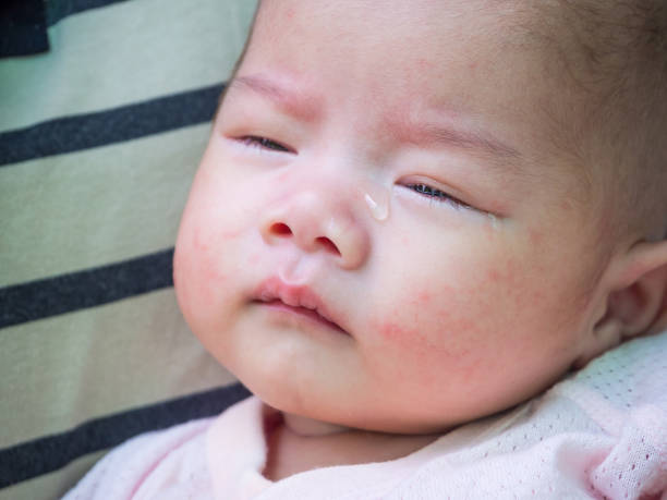 istock newborn baby with allergy on face 925553194