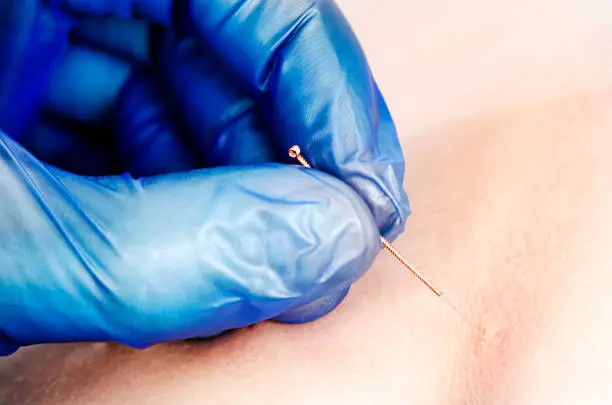 Photo of Needle and hands of physiotherapist doing a dry needling