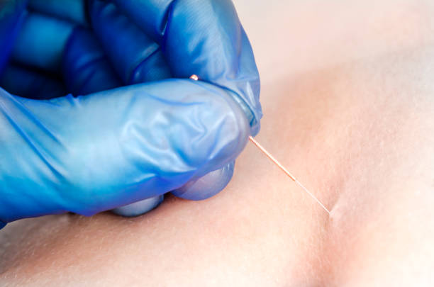 istock Needle and hands of physiotherapist doing a dry needling 925778856