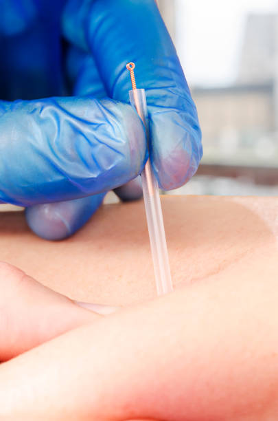 istock Needle and hands of physiotherapist doing a dry needling 925779000