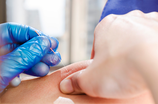 Closeup of a needle and hands of physiotherapist doing a dry needling.