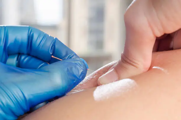 Closeup of a needle and hands of physiotherapist doing a dry needling.