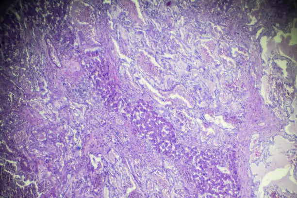 Photo of Hemangioma biopsy under light microscopy